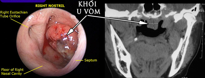 Nội soi khối u vòm họng trước khi điều trị Nội soi khối u vòm họng trước khi điều trị