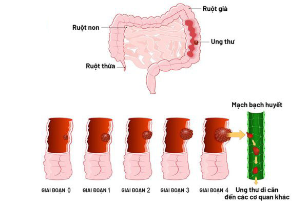 Các giai đoạn ung thư đại tràng Các giai đoạn ung thư đại tràng