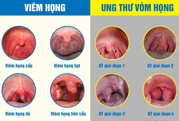 Các biểu hiện khác nhau giữa viêm họng và ung thư vòm họng Các biểu hiện khác nhau giữa viêm họng và ung thư vòm họng